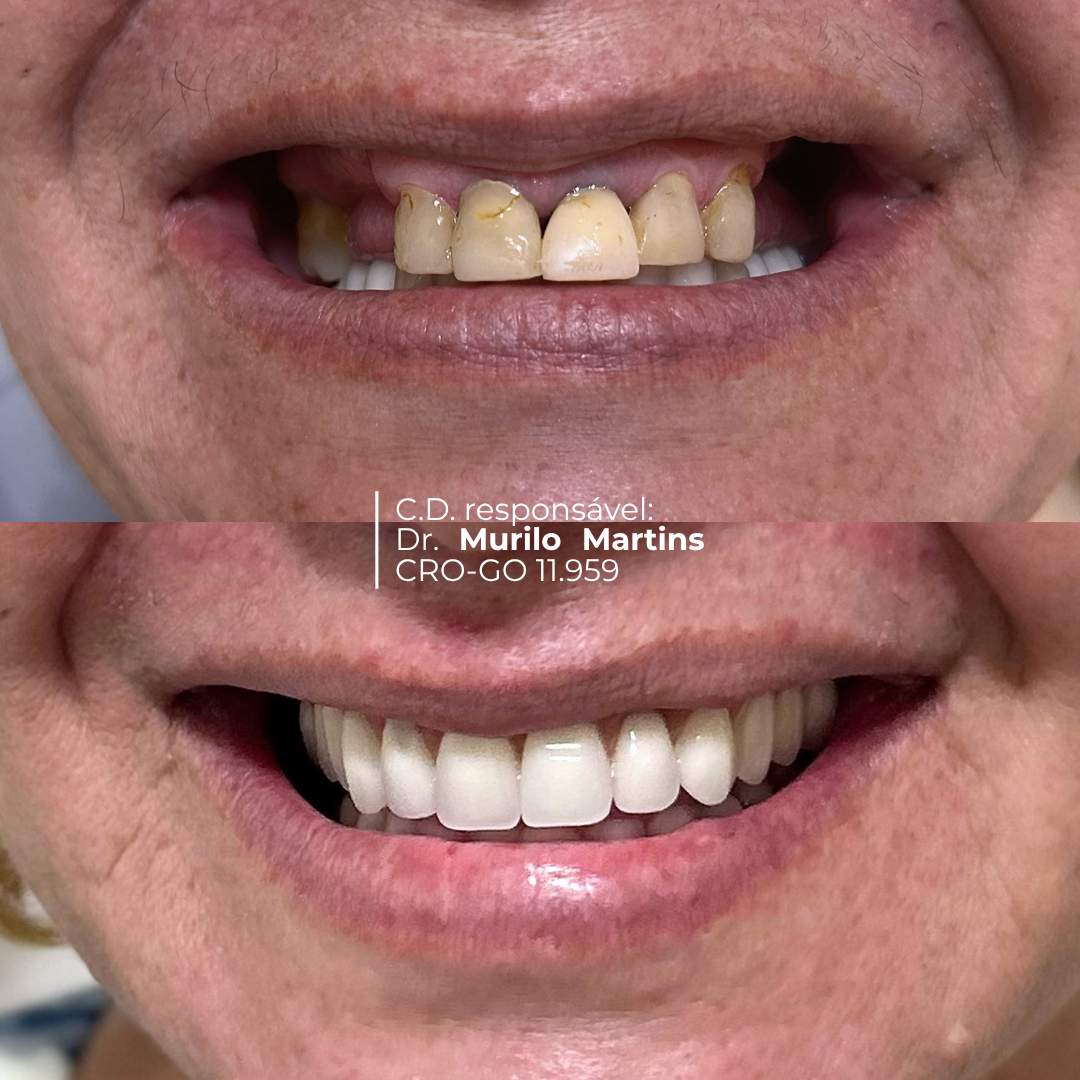 Antes e depois de sorriso - Para quem é